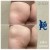 Butt Lift treatment 12 thumbnail