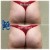 Butt Lift treatment 14 thumbnail