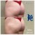 Butt Lift treatment 16 thumbnail
