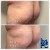 Butt Lift treatment 17 thumbnail