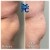 Butt Lift treatment 2 thumbnail