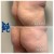 Butt Lift treatment 20 thumbnail