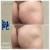 Butt Lift treatment 21 thumbnail