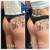 Butt Lift treatment 24 thumbnail