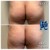Butt Lift treatment 4 thumbnail
