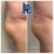Butt Lift treatment 5 thumbnail