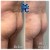 Butt Lift treatment 6 thumbnail