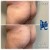 Butt Lift treatment 7 thumbnail