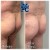 Butt Lift treatment 8 thumbnail