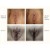 CO2 Lift® V case 5 thumbnail