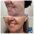 Dilute Radiesse treatment 11 thumbnail