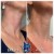 Dilute Radiesse treatment 18 thumbnail