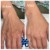 Dilute Radiesse treatment 2 thumbnail