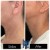 Dilute Radiesse treatment 21 thumbnail