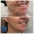 Dilute Radiesse treatment 23 thumbnail