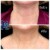 Dilute Radiesse treatment 25 thumbnail