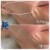 Dilute Radiesse treatment 27 thumbnail