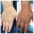 Dilute Radiesse treatment 28 thumbnail