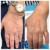 Dilute Radiesse treatment 29 thumbnail