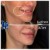 Dilute Radiesse treatment 30 thumbnail