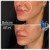 Dilute Radiesse treatment 31 thumbnail