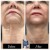 Dilute Radiesse treatment 5 thumbnail