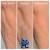 Dilute Radiesse treatment 7 thumbnail
