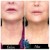 Dilute Radiesse treatment 8 thumbnail