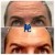 Upper Face Tox treatment 1 thumbnail