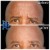 Upper Face Tox treatment 2 thumbnail