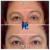 Upper Face Tox treatment 4 thumbnail