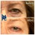 Upper Face Tox treatment 5 thumbnail