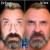 Upper Face Tox treatment 6 thumbnail