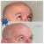 Upper Face Tox treatment 8 thumbnail