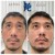 Upper Face Tox treatment 9 thumbnail