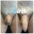 P-Girth Retention case 13 thumbnail