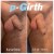 P-Girth® Uncircumcised penis augmentation case 27 thumbnail