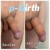 P-Girth® Uncircumcised penis augmentation case 33 thumbnail