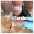 Glans augmentation treatment case 3 thumbnail