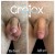 GroTox® treatment 19 thumbnail