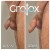 GroTox® treatment 31 thumbnail