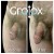 GroTox® treatment 5 thumbnail