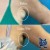 Lipodissolve treatment 1 thumbnail