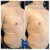Lipodissolve treatment 13 thumbnail