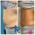 Lipodissolve treatment 16 thumbnail