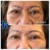 Lipodissolve treatment 4 thumbnail