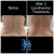 Lipodissolve treatment 5 thumbnail