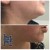 Lipodissolve treatment 6 thumbnail