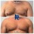 Lipodissolve treatment 8 thumbnail