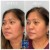 Lower Face Filler treatment 1 thumbnail